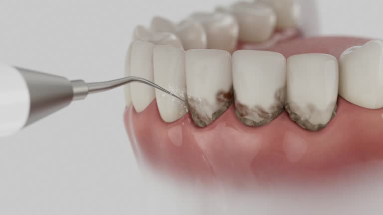 Reliable Dental Implants contractor in Bowling Green, OH by Smile Center Dentistry